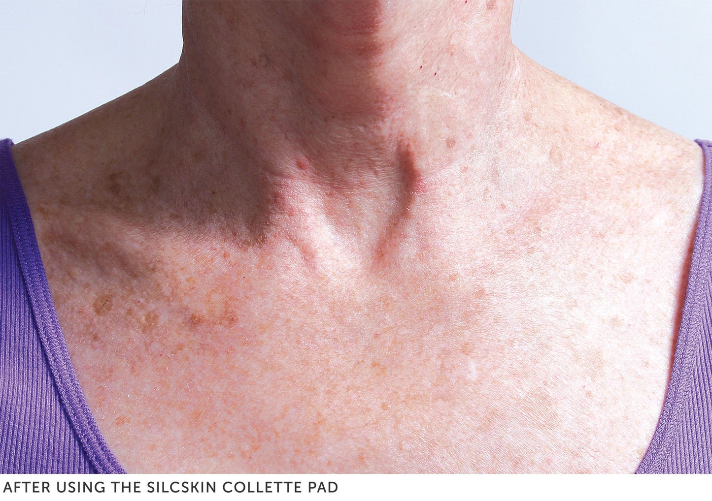 Collette Pad (neck) - TheDermalFormula