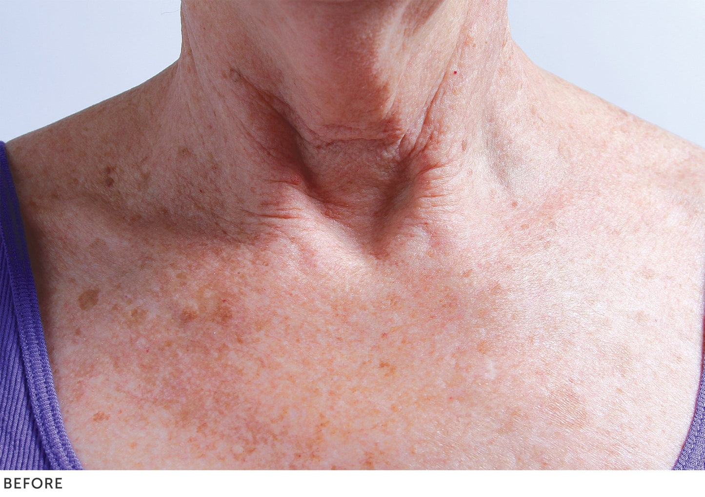 Collette Pad (neck) - TheDermalFormula